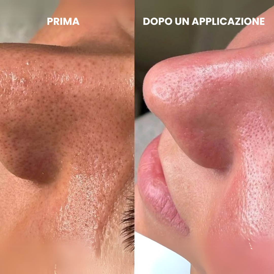 Cerotti Idrocolloidali per una Pelle Pulita e Senza Imperfezioni